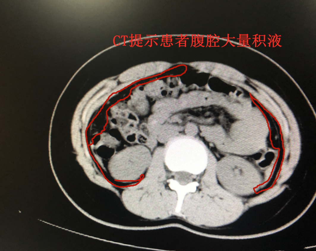 卵巢黄体破裂花季少女险休克专家提醒女性出现不明原因腹痛需重视