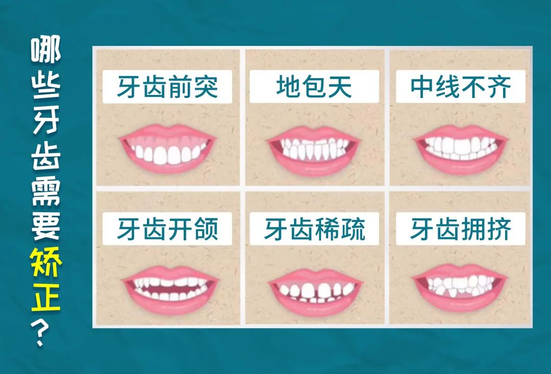 哪些牙齿需要矫正?