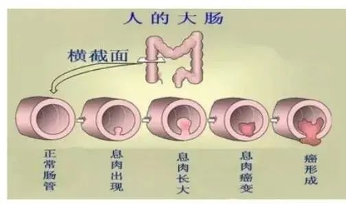 痔疮竟变肠癌平均每分钟就有一人确诊