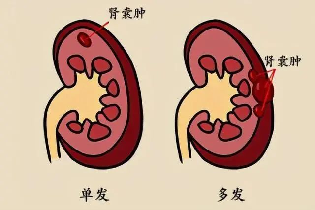 肾囊肿的发生及症状很多人在体检肾脏彩超会发现"肾脏低回声病灶"