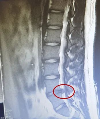 15岁男孩腰椎间盘突出用土方治疗谁知腰上竟烂了三个洞