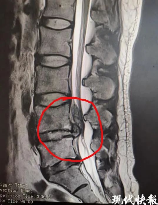 腰椎间盘突出