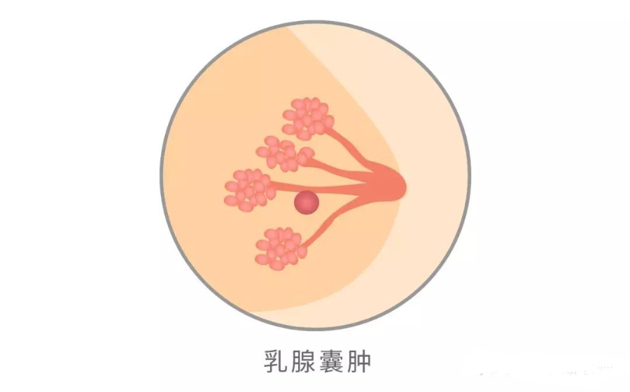 查出囊肿心慌慌别怕从这几点正确认识乳腺囊肿