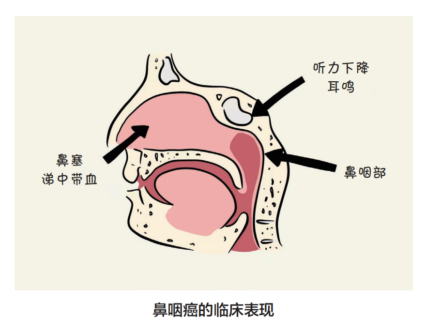 鼻咽癌易发生颈部淋巴结转移,在首诊的患者中有 60 是因为发现颈部