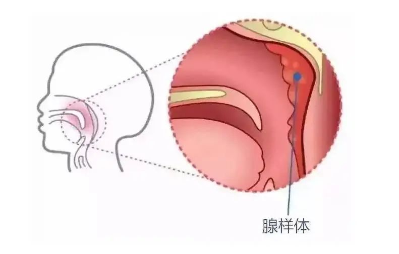 娃睡觉打鼾张口越长越丑腺样体肥大一定要手术吗