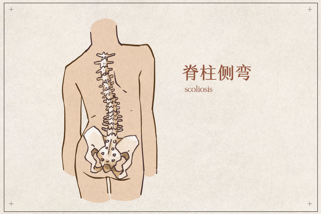 脊柱侧弯如何矫正专科医生这样说