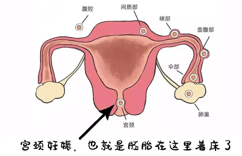 而有些胚胎由于过分"调皮,好好的房子"宫腔"搁