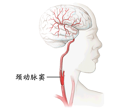 颈动脉窦恰好位于人体较为脆弱的颈部,因而说它是人类的"七寸"并不