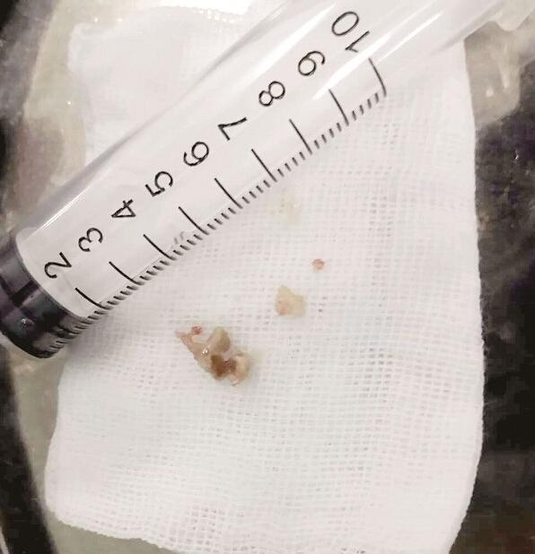 女童吃鸭脖 碎骨入肺6次手术取出_长江云 - 湖北