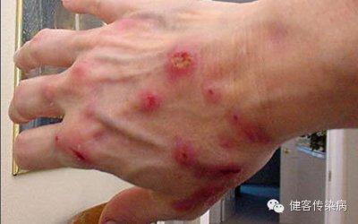 6旬婆婆被蜱虫咬后不治身亡近期湖北已有多人中招