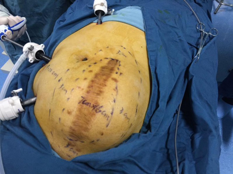 小疝不补成大疝 男子肚子像怀孕五月