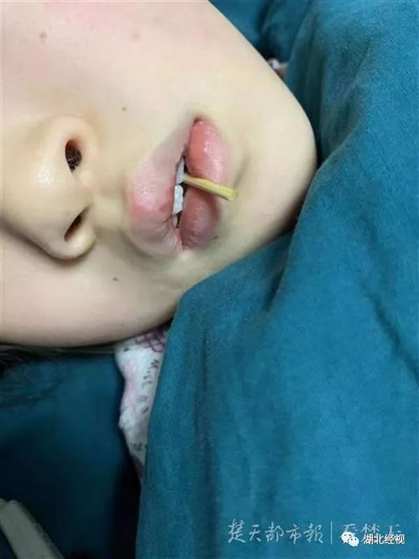 站稳,整个人向前倾倒,穿热狗的竹签笔直戳进口腔,只剩一点还留在嘴边