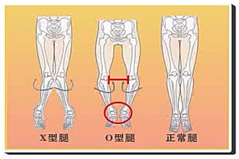 人們常說的x型腿或o型腿,用科學的術語來講,其實是膝內翻和膝外翻.