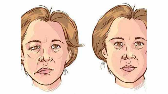 小伙突发口角歪斜以为中风经诊断为周围性面瘫