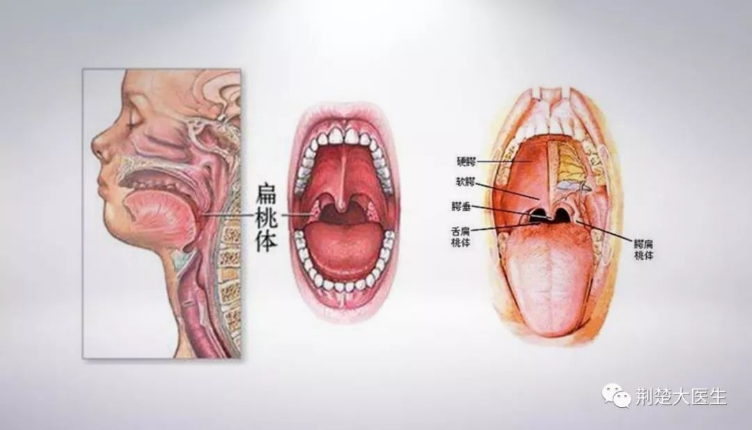 荊楚大醫生|扁桃體炎別忽視 守第一道防線