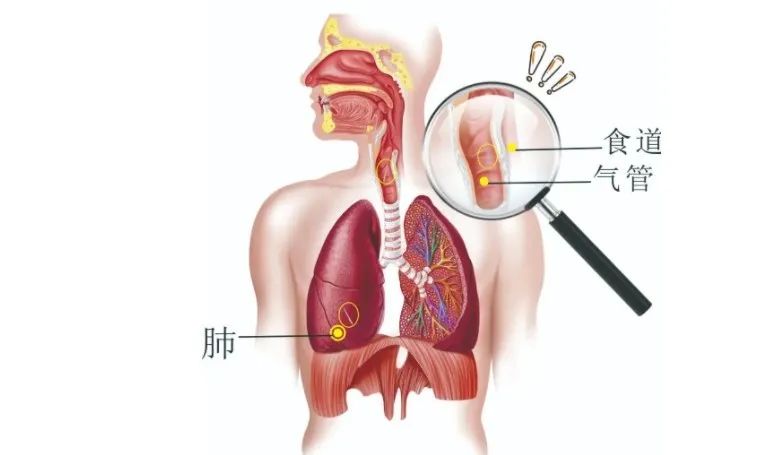 使魚刺脫落2,看得到的魚刺,可以用鑷子取若卡在肉眼能見到較淺的位置