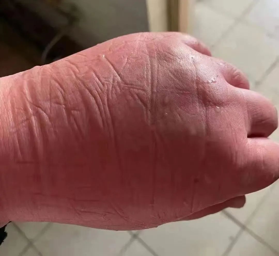 这双手的主人找到了布满勒痕的护士的手照片里是一只被冻得像馒头一样