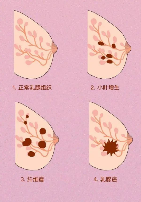 乳腺增生B超图片图片