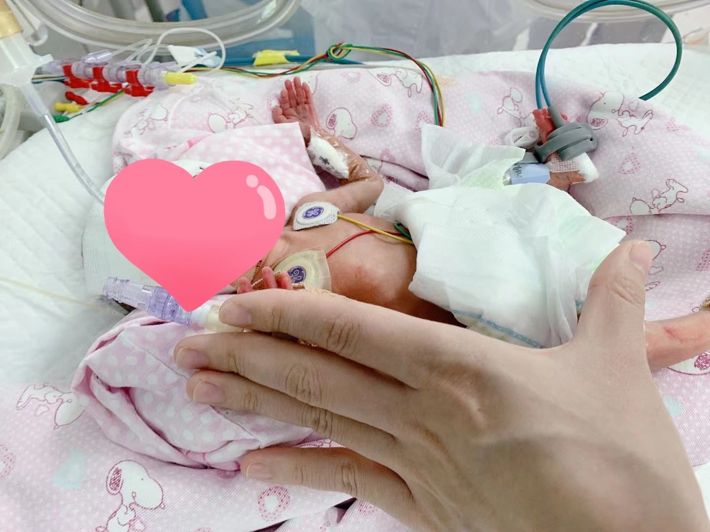 27周3天即出生体重仅650克医护精心救治104天后巴掌宝宝康复出院