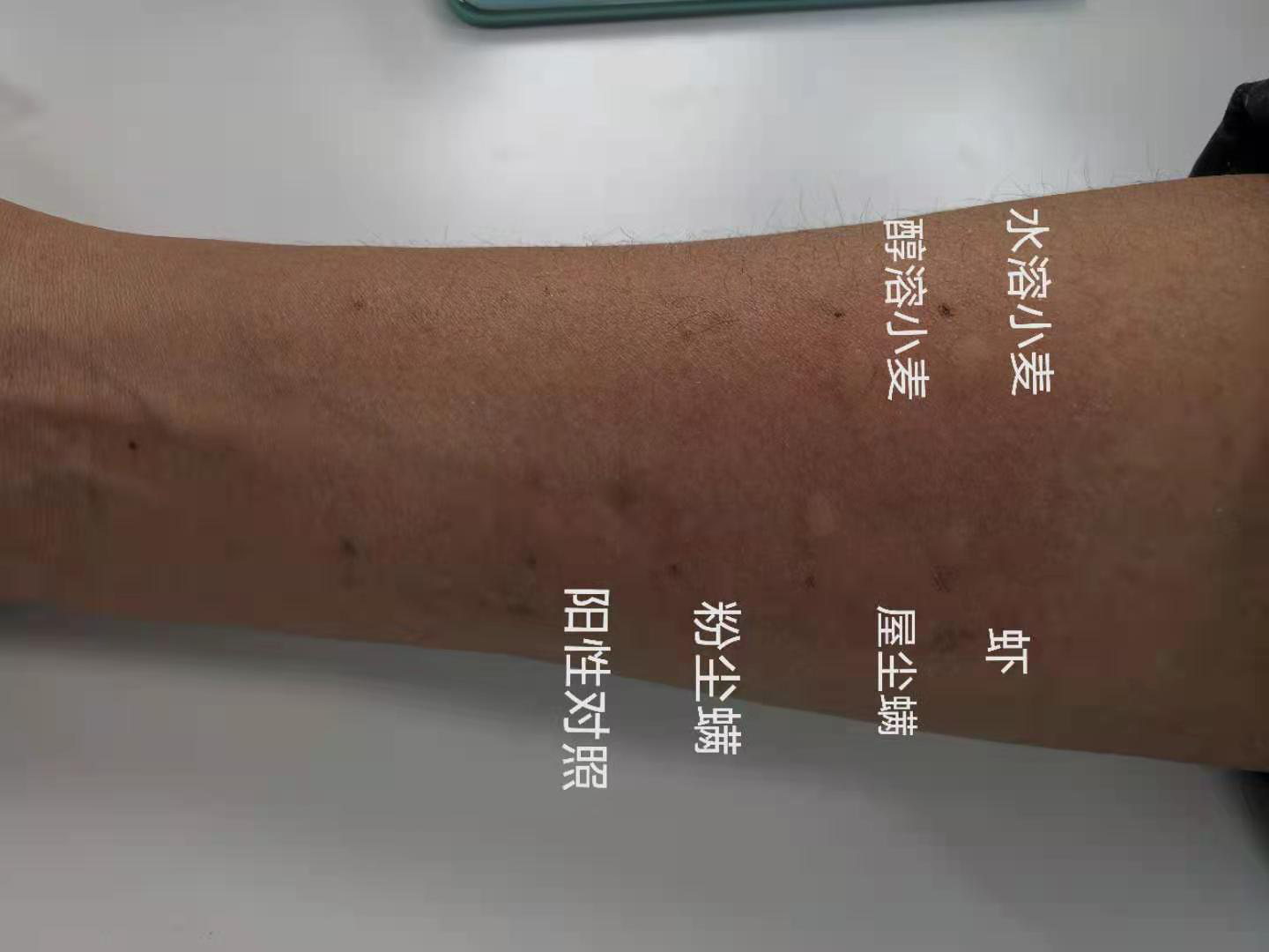 对食物过敏患者,购买食品时,要仔细阅读包装袋上的配料表或过敏原信息