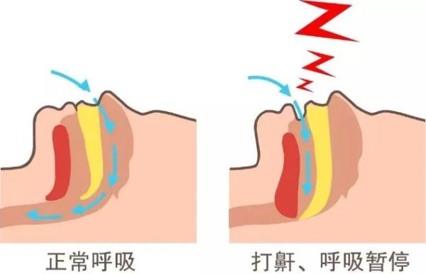 即睡眠中会呼吸暂停,甚至突然被憋醒