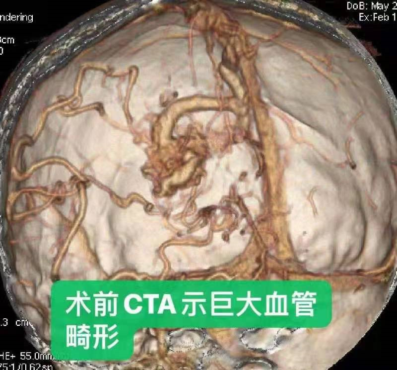 经检查提示,张女士颅内巨大血管畸形,当时已经血管破裂出血,右顶枕叶