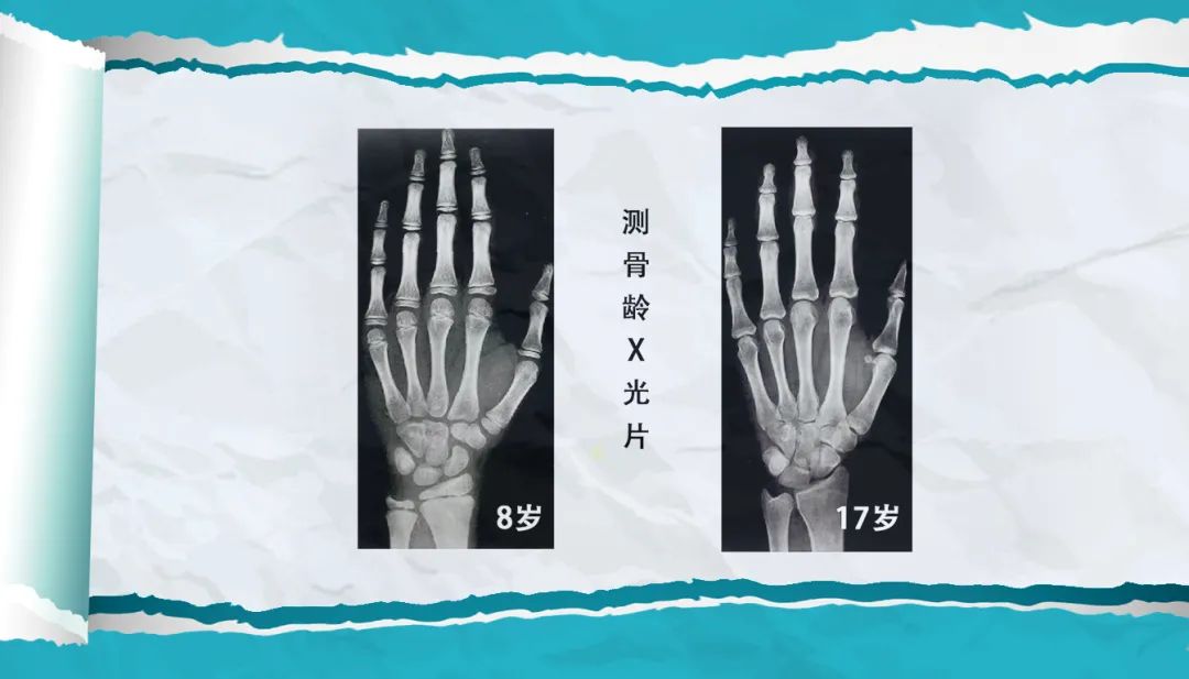 有的孩子手腕的骨龄片基本上快闭合了,但如果下肢骨骺线没有完全闭合