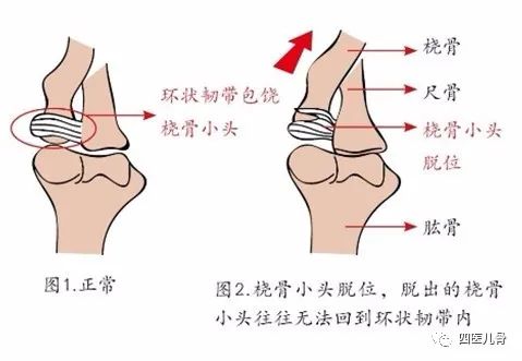 响声,数分钟后一般疼痛感可缓解,上肢活动恢复正常,表明桡骨头已复位