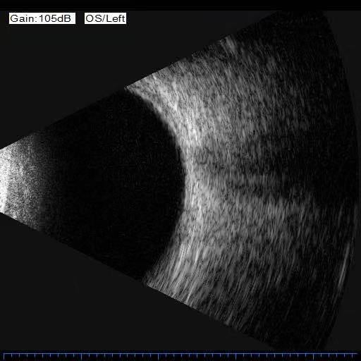 湖北首例武汉大学人民医院眼科开展超高速玻切手术造福糖尿病视网膜