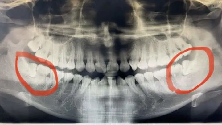 智齿诊断证明图片