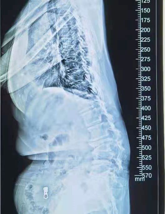經過檢查,胡先生被確診為腰椎後凸畸形,並伴有一定程度的側彎和腰椎管