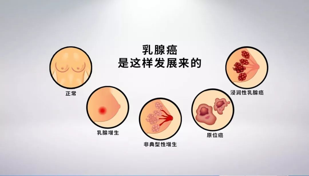 癌细胞大部分位起源于乳腺导管内,有些起源于乳腺小叶,还有少量起源于