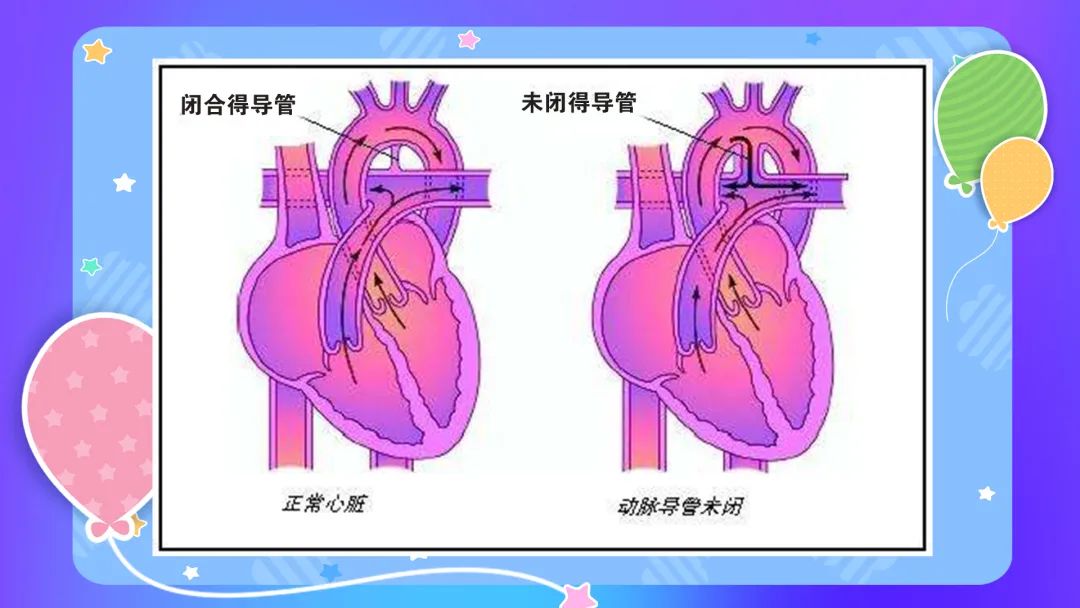 動脈導管未閉的原因是什麼?