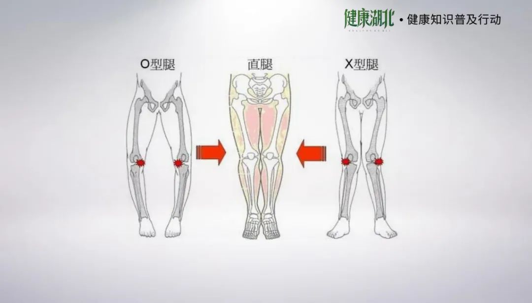 膝后夹角图片