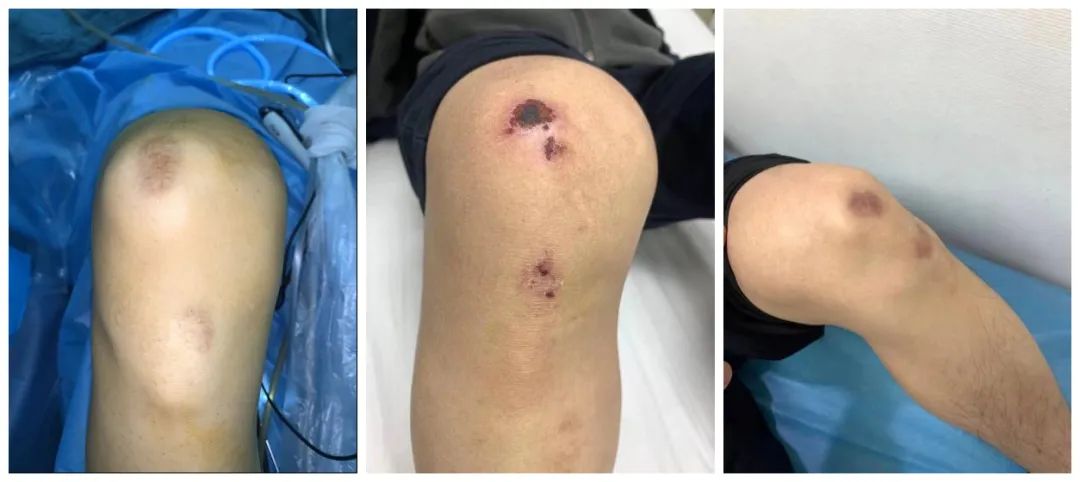 感到惊讶的是,他们伤处的外观也非常一致:膝盖留有一上一下两个疤痕