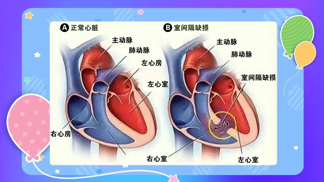 心脏的左心室和右心室间隔被称为室间隔,完整的室间隔能够阻挡左,右