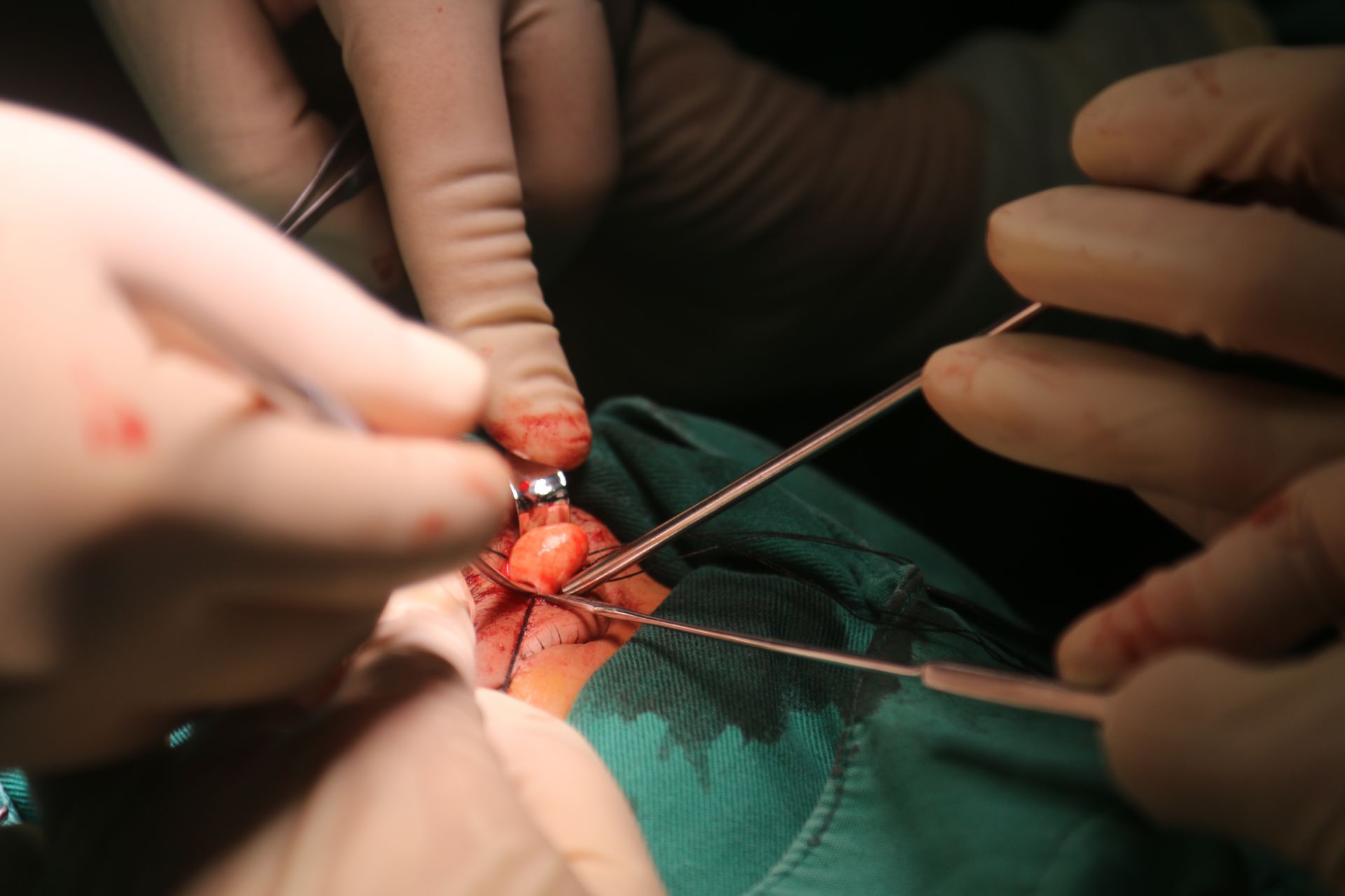 7×1.0×0.7cm的囊肿.