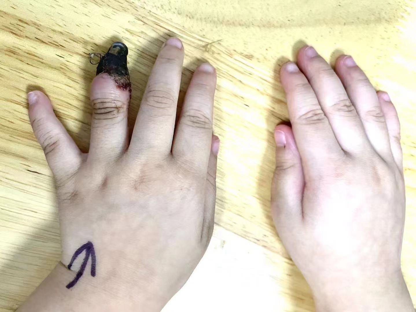 痛心家人错误包扎3岁女童手指被截肢协和专家提醒创口贴使用也有大学