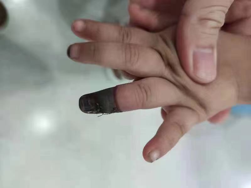 痛心家人错误包扎3岁女童手指被截肢协和专家提醒创口贴使用也有大学