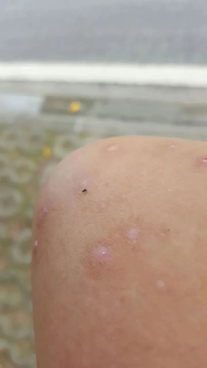 这种小飞虫咬人比蚊子猛6招能治它疾