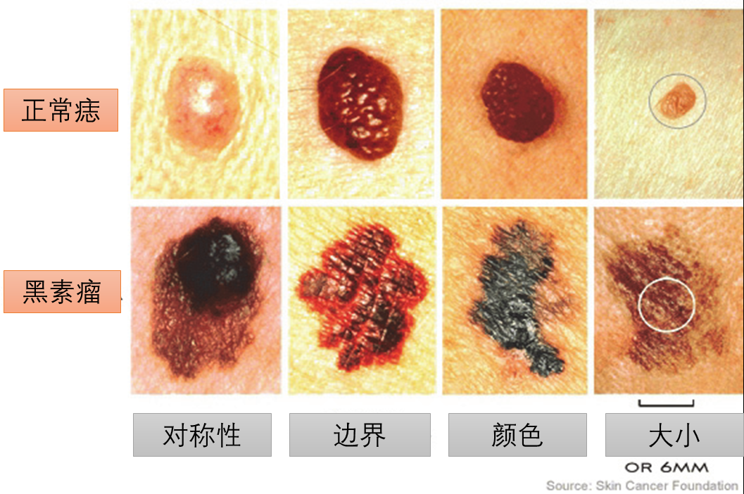 恶性黑色素瘤图片_恶性素瘤是什么_黑色恶性素瘤能活多久