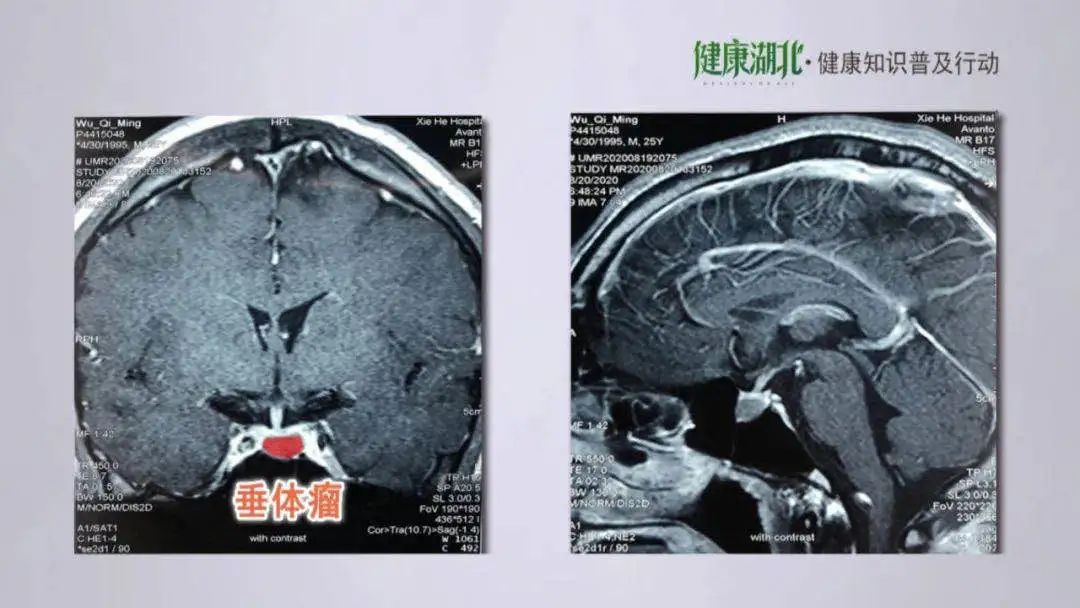 ct掃描3.磁共振成像(mri)4.氣腦和腦血管造影怎樣合理治療垂體瘤?