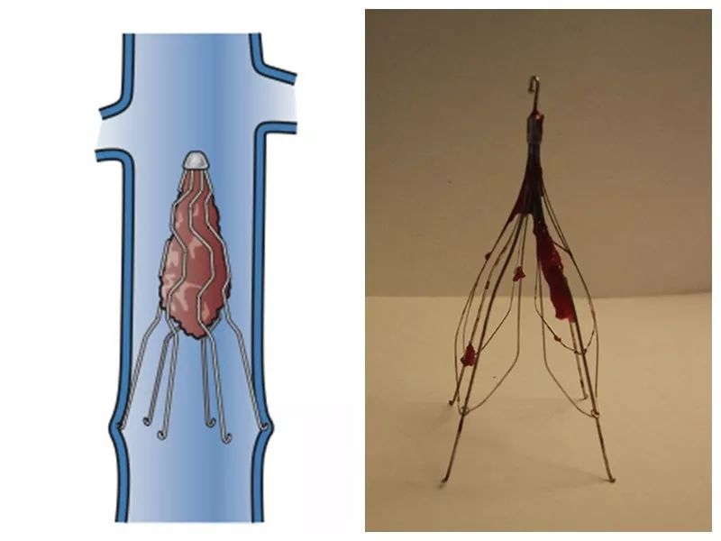 肺栓塞滤器图片
