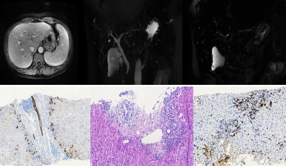可能有多种肝病,如果无法确诊就无法精准治疗,只有进行肝脏穿刺病理
