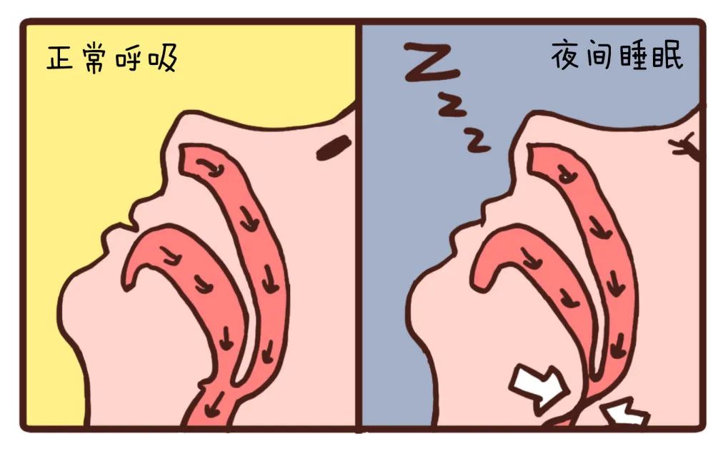 要了解这个问题,我们要先知道呼噜声产生的原理.