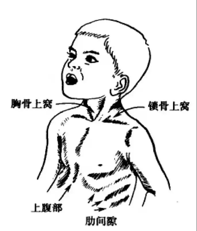 的呼吸困难,重症者可能出现"四凹征"(即胸骨上窝,锁骨上窝,肋骨间隙
