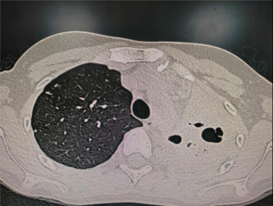 左肺(影像中为右侧)毁损严重2019年,小夏因肺部不适来武汉市肺科医院