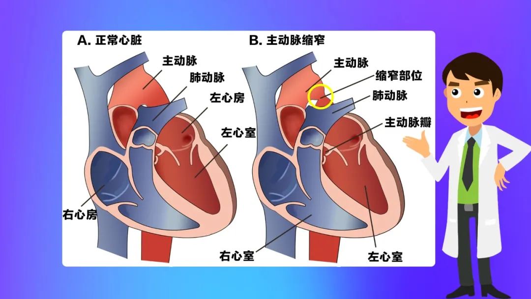 先心病(無青紫型):主動脈縮窄此類先心病是最為嚴重的一型,包括法洛