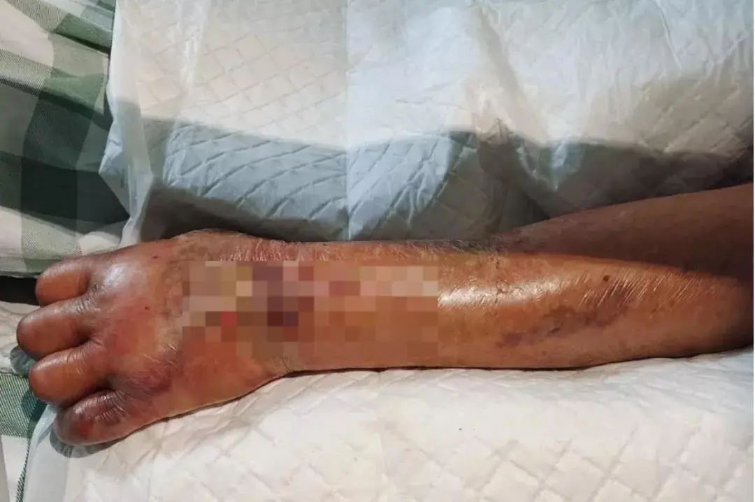 被它扎的后果只有截肢才能保命