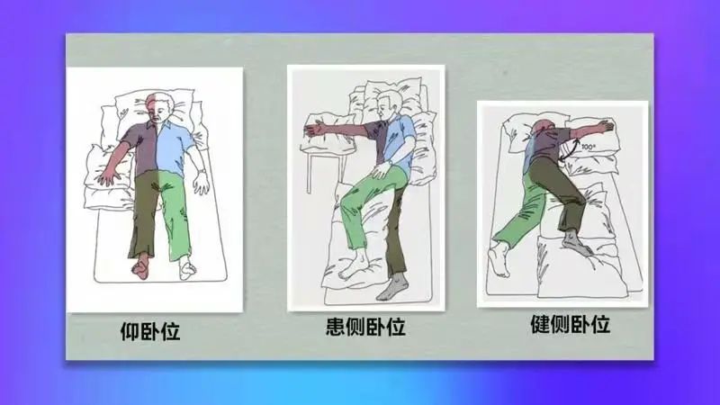 良肢位摆放急性期的康复治疗以预防为主,主要是预防与卧床有关的并发